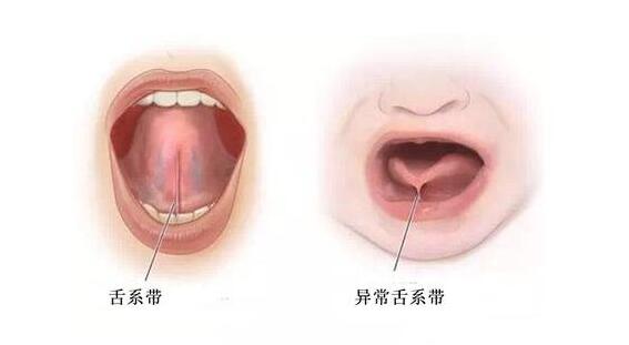 大舌头异常对比